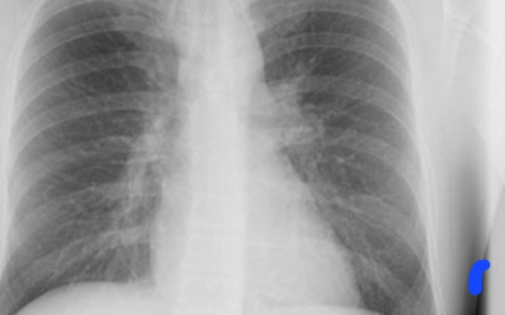 Zbiórka Na rehabilitację kręgosłupa. - zdjęcie główne