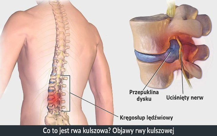 Zbiórka Leczenie kregoslupa - dyskopatia - zdjęcie główne