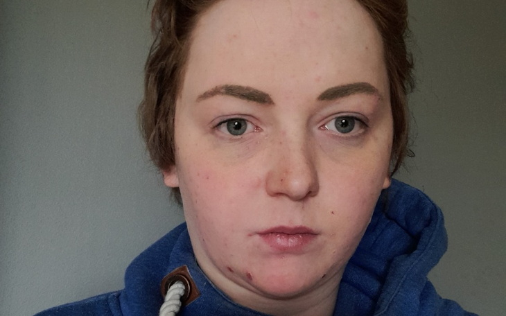 Zbiórka Leczenie tocznia oraz AZS - zdjęcie główne