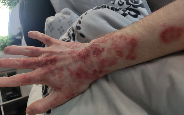 Zbiórka Łuszczyca, która nie pozwala żyć - zdjęcie główne