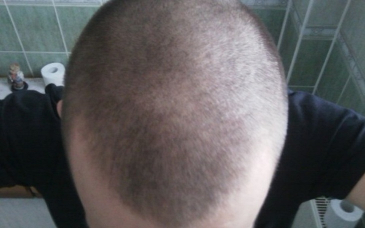 Zbiórka Zbieram na Czapkę dla łysego :D - zdjęcie główne