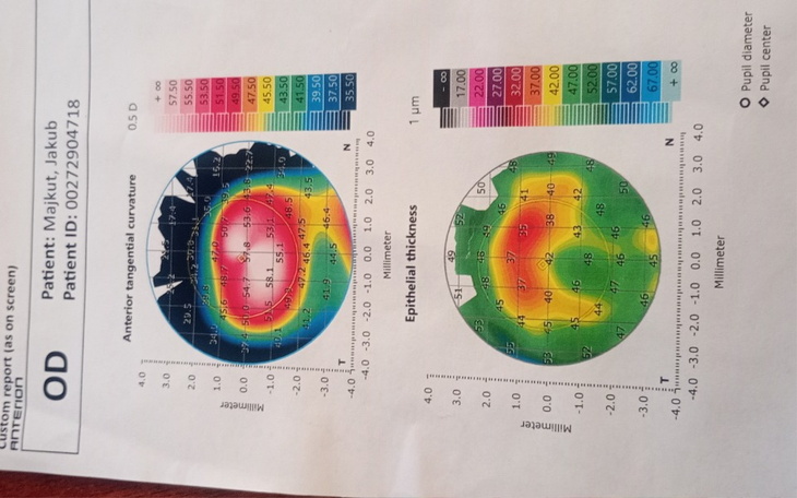 Zbiórka Operacja oka Cross - Linking - zdjęcie główne