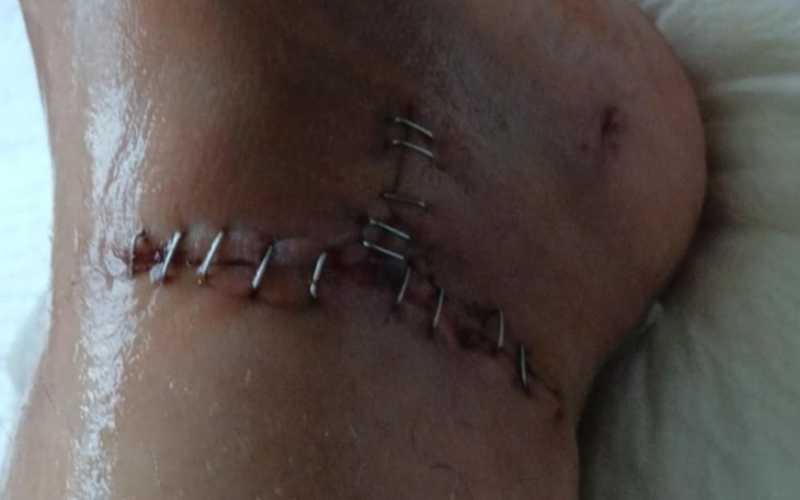 Zbliżenie na ranę pooperacyjną na kolanie, z szwami.