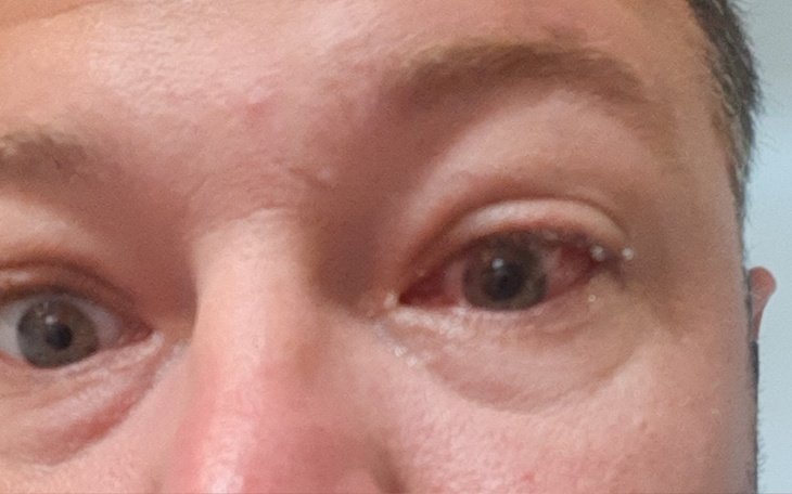 Zbiórka Na operacje siatkowki - zdjęcie główne