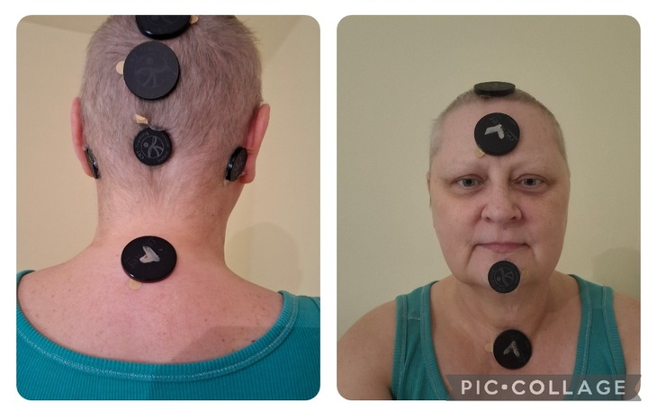 Osoba z łysą głową i magnesami na czole.