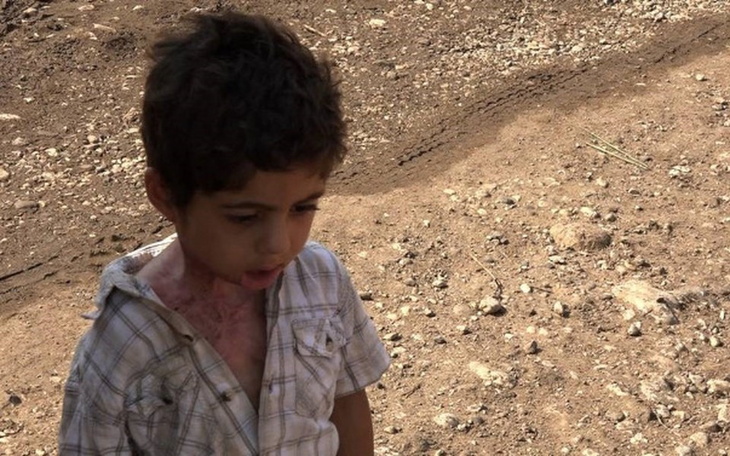 Chłopiec z bliznami, stojący na ziemi.