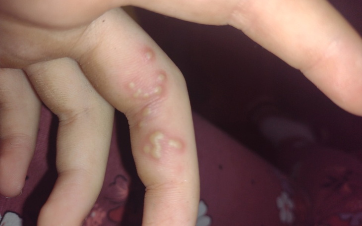 Zbiórka Leczenie na poparzenie - zdjęcie główne