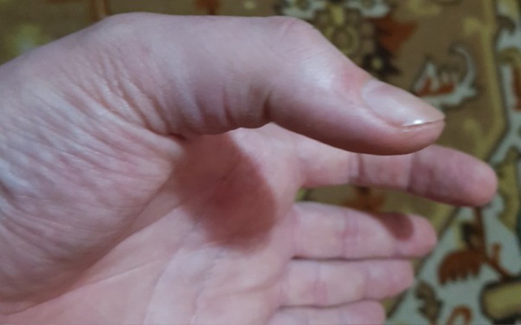 Zbiórka Operacja uwolnienie ścięgna - zdjęcie główne