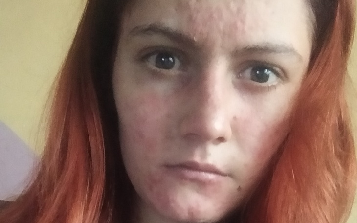 Zbiórka Na leczenie oczu twarzy - zdjęcie główne