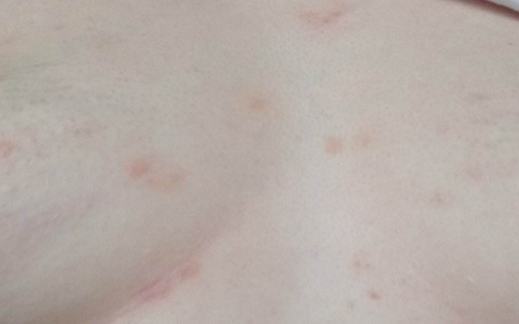 Zbiórka Zbieram na badanie u dermatolog - zdjęcie główne