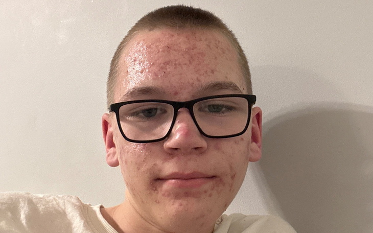 Młody chłopak z okularami, z widocznymi zmianami skórnymi.