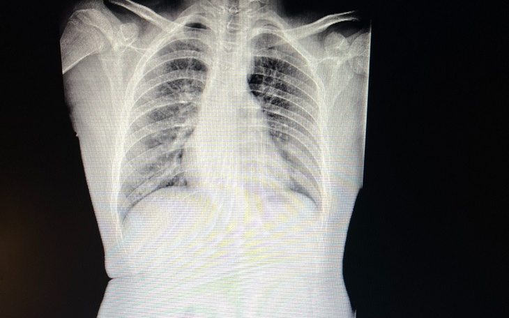 Zbiórka STOP skoLioza - zdjęcie główne