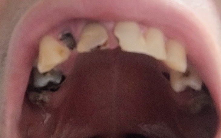 Zbliżenie na zęby z próchnicą, otwarta jama ustna.