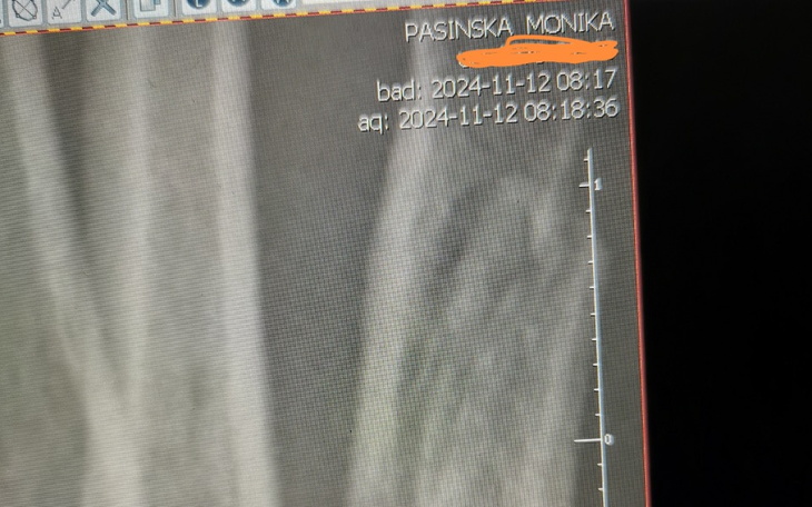 Zbiórka Operacja zespolenia kości stopy - zdjęcie główne