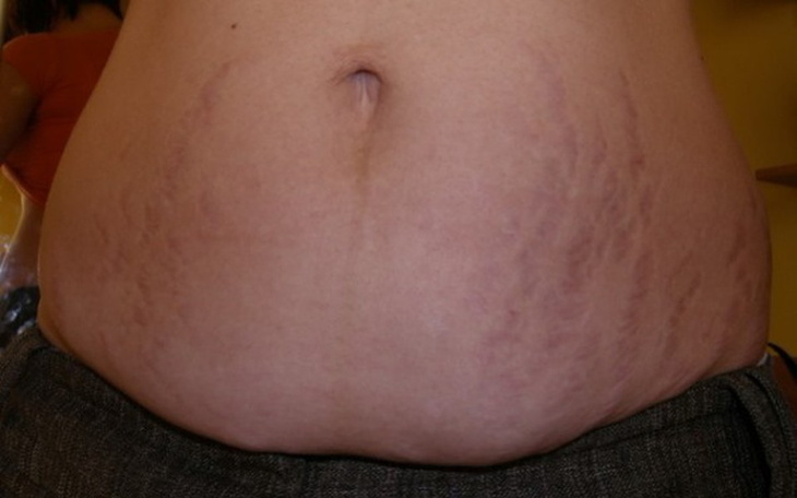 Zbiórka na usunięcie blizn - zdjęcie główne