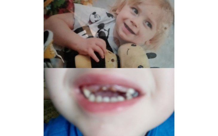 Dziecko z uśmiechem, z widocznymi brakującymi zębami.