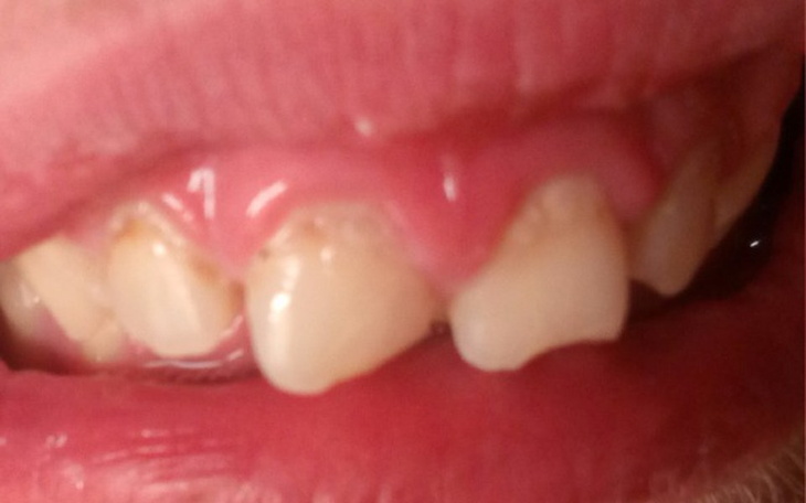 Zbiórka Naprawa zębów naczyniak jamisty - zdjęcie główne