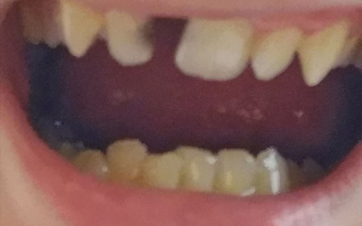 Zbiórka Wstawienie zęba jedynki - zdjęcie główne