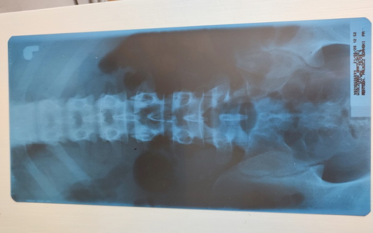 Zbiórka Operacja kręgosłupa Bartka - zdjęcie główne