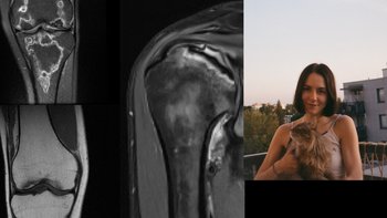 Zbiórka Na leczenie martwicy kości - miniaturka zdjęcia