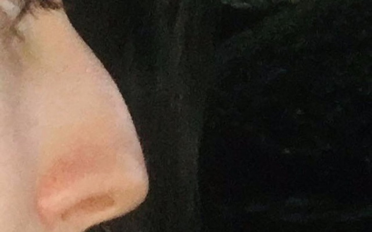 Zbiórka Operacja repozycji nosa. - zdjęcie główne