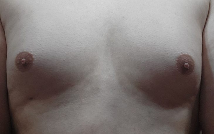 Zbiórka Zbieram na operacje Piersi Trans - zdjęcie główne