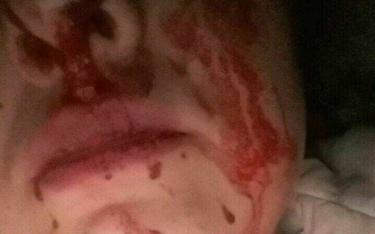 Zbliżenie na twarz z krwią, sugerujące poważny uraz.
