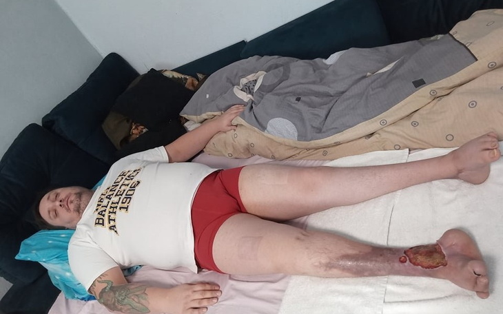 Zbiórka Michałowi grozi amputacja Pomóż - zdjęcie główne