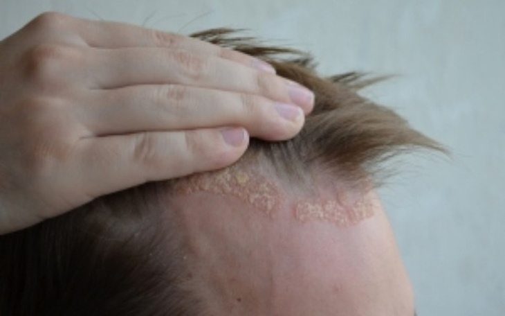 Zbiórka Łuszczyca to choroba skóry - zdjęcie główne