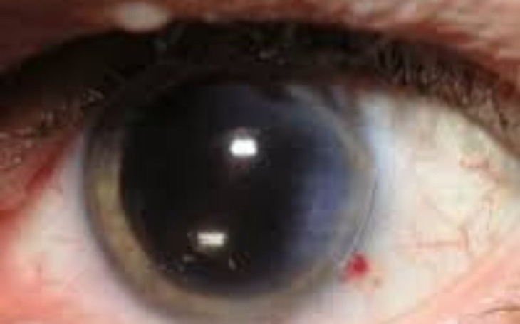 Zbiórka Na operacje oczu - zdjęcie główne