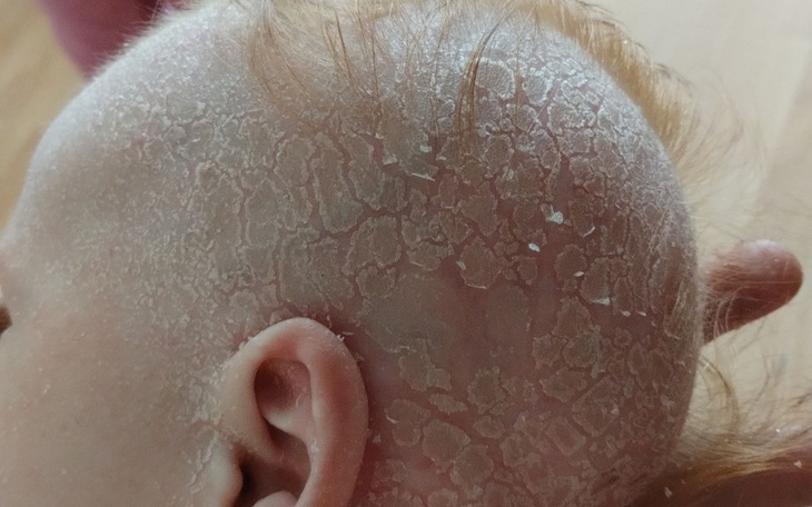 Zbiórka Leczenie atopowej skóry - zdjęcie główne