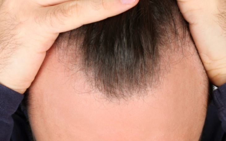 Mężczyzna trzymający się za głowę, z widoczną łysiną.