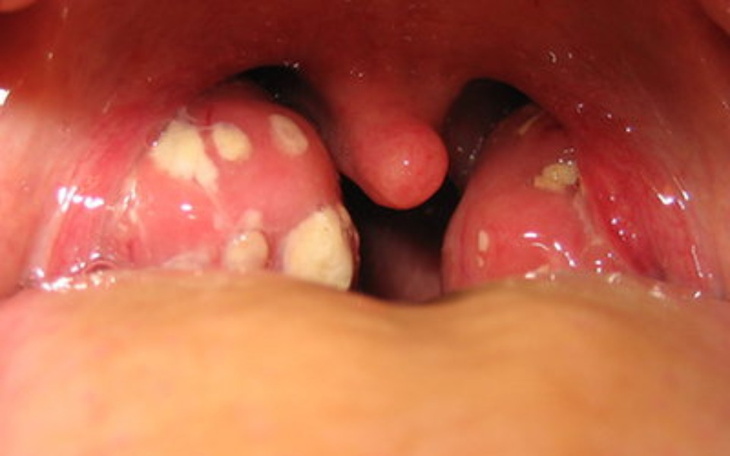 Zbiórka Na zabieg wycięcia migdałów - zdjęcie główne