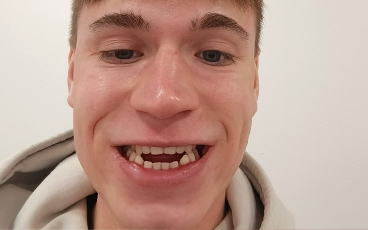 Zbiórka Aparat ortodontyczny/nakładki - zdjęcie główne