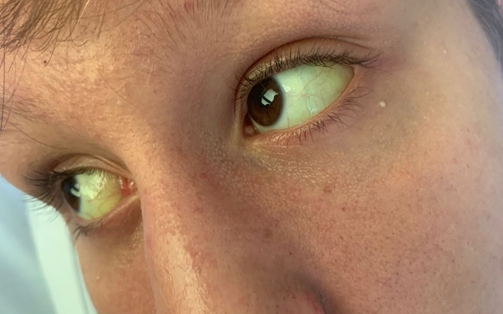 Zbliżenie na oczy osoby z żółtaczką, ważny temat zdrowotny.