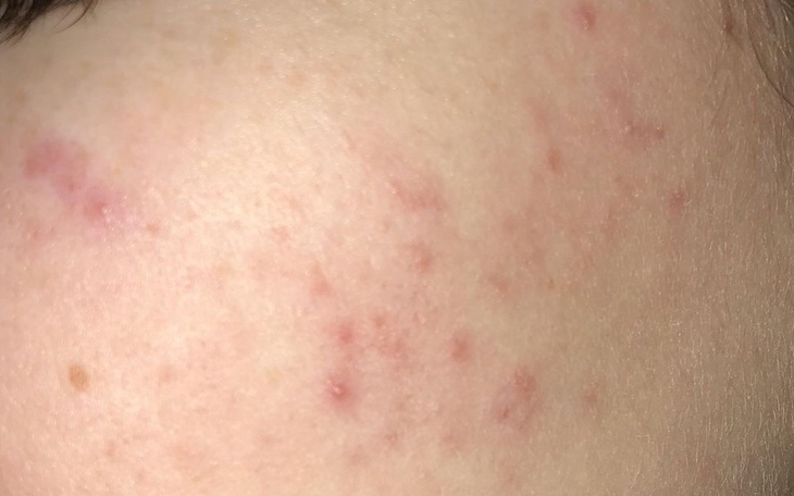 Zbiórka Zbiórka na wizytę u dermatologa - zdjęcie główne