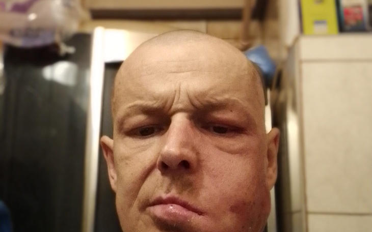 Zbiórka na leczenie chlonniaka DLBCL - zdjęcie główne