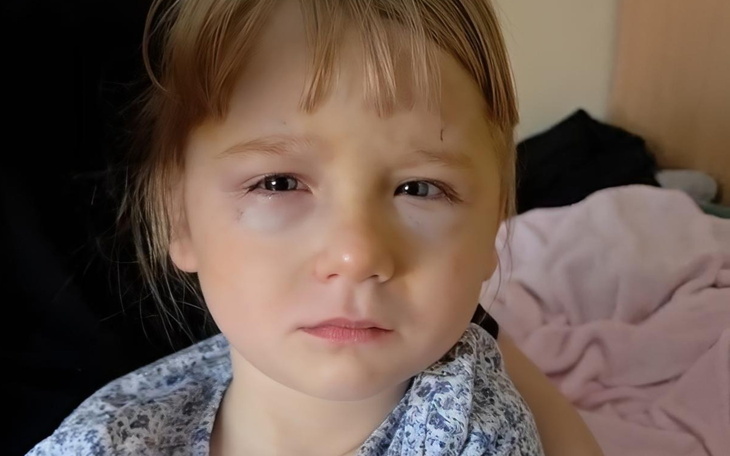 Dziecko z siniakiem na twarzy, wygląda na zmartwione.