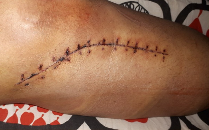 Zbiórka Rehabilitacja kolana Oli N - zdjęcie główne