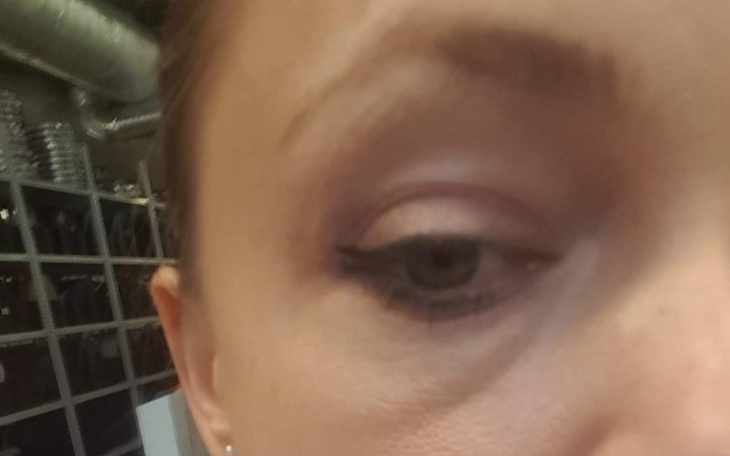 Zbiórka Operacja plastyczna powiek dolny - zdjęcie główne