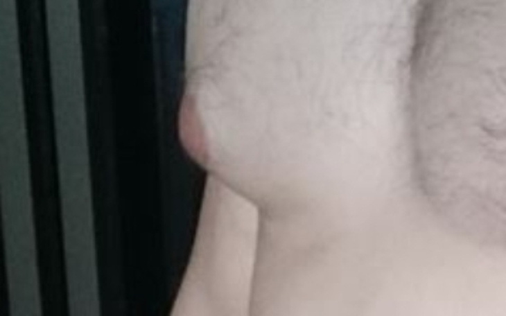 Zbiórka Zabieg ginekomasti - zdjęcie główne