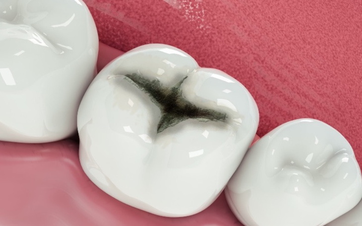 Zbiórka Plomby amalgamatowe - usunięcie - zdjęcie główne