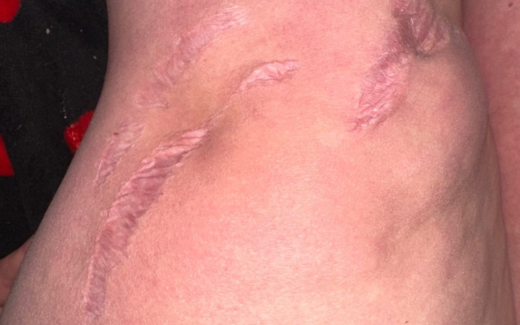 Widok blizn na ciele, symbolizujących trudne doświadczenia.