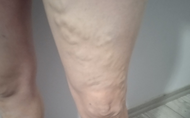 Zbiórka Marzenie o operacji żylaków - zdjęcie główne