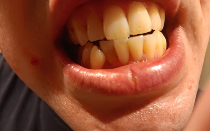 Zbiórka Aparat na krzywego ząbka - zdjęcie główne