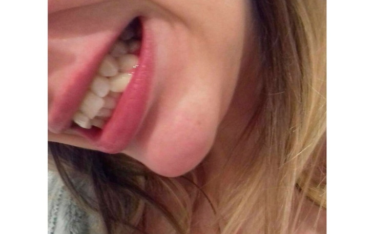 Zbiórka laczenie aparatem ortodontycznym - zdjęcie główne