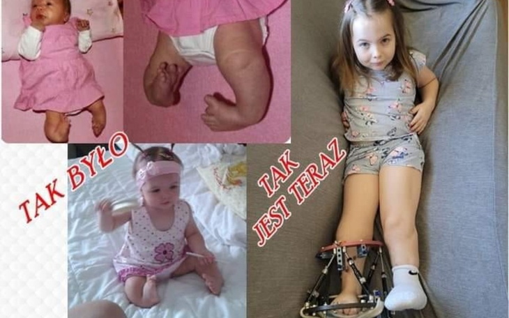Porównanie zdjęć dziewczynki z dzieciństwa i obecnie.
