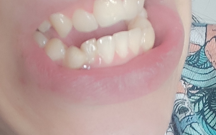 Zbiórka Wada operacyjna szczęki - zdjęcie główne