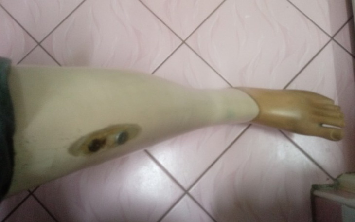 Zbiórka Zbieram na proteze lewej nogi - zdjęcie główne