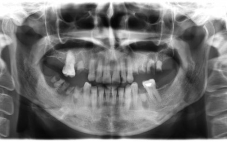 Zbiórka zbieram na ząbki - zdjęcie główne